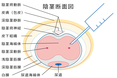 陰茎注射