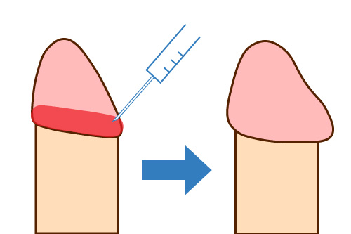 亀頭の冠部に注射