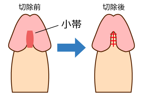 小帯切除のイメージ