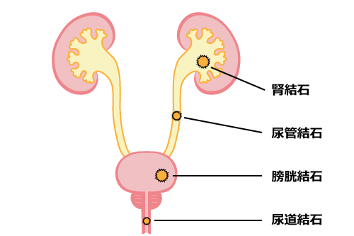 尿路結石ができる部位