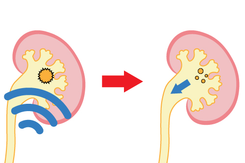 体外衝撃波結石破砕術