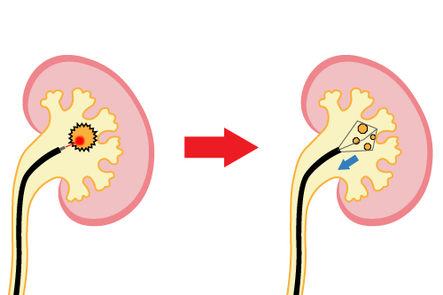 経尿道的尿路結石破砕術
