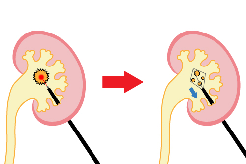 経皮的腎結石破砕術