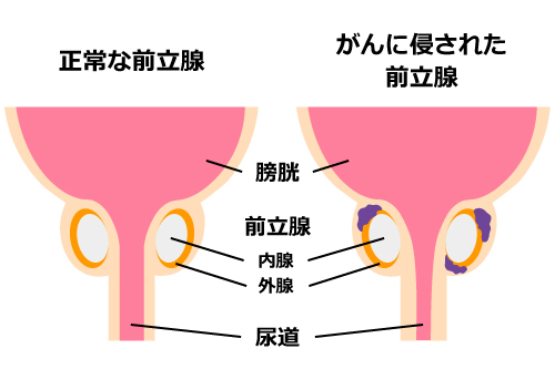 前立腺がんのイメージ