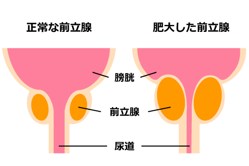 前立腺肥大症のイメージ